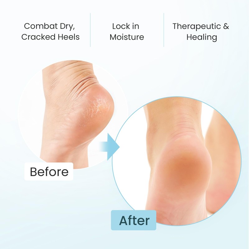 Welnove Moisturizing Heel Socks for Cracked Feet, 2 Pairs Foot
