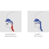 Snorban, One-piece anti-snoring splint, snoring stopper for a restful sleep
