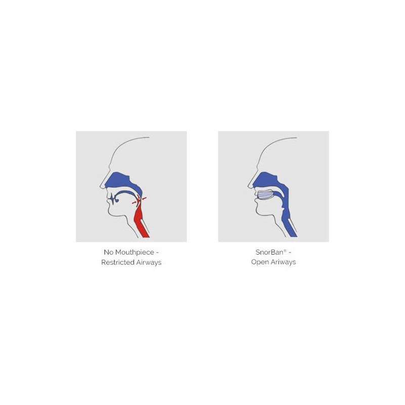 Snorban, One-piece anti-snoring splint, snoring stopper for a restful sleep