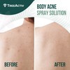 TreeActiv Salicylic Acid Back & Body Acne Spray, Back Acne