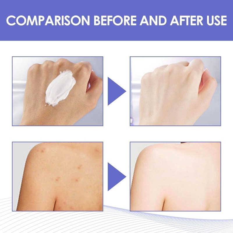Crema Aclaradora de Partes Intimas de Axilas, Crema para Manchas