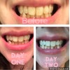 Smile Titan Teeth Whitening Gel Refill 4X Syringes 44% Carbamide