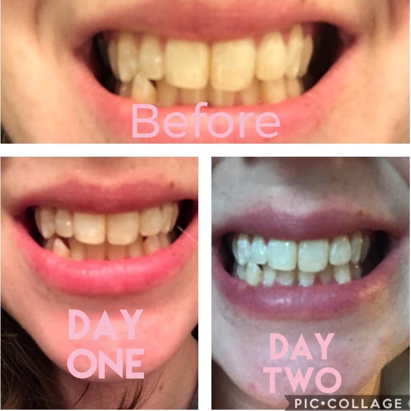 Smile Titan Teeth Whitening Gel Refill 4X Syringes 44% Carbamide