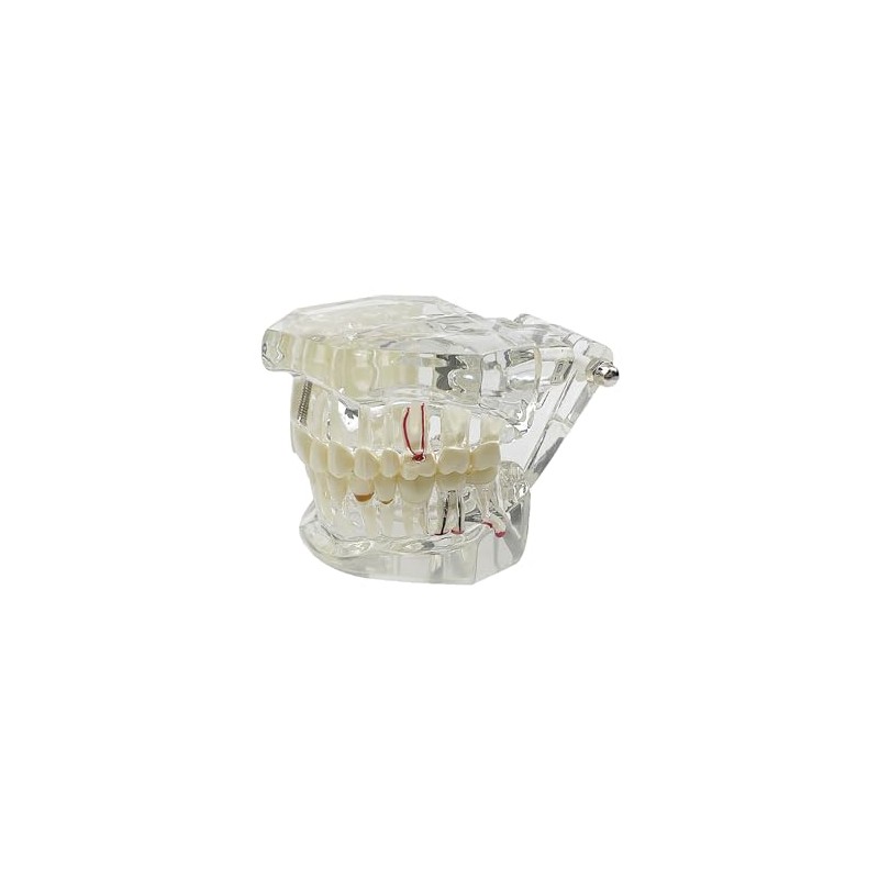 Modelo de implante de dientes, para enseñanza, modelo de enfermedad,