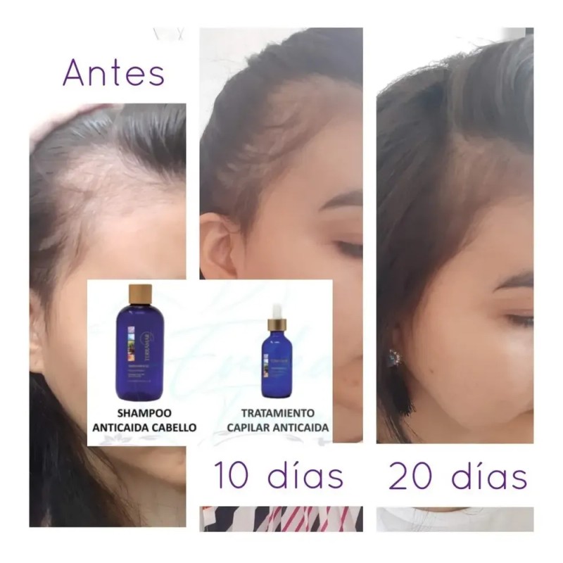 Set Anti Caída Shampoo Y Tratamiento Terramar + Gel