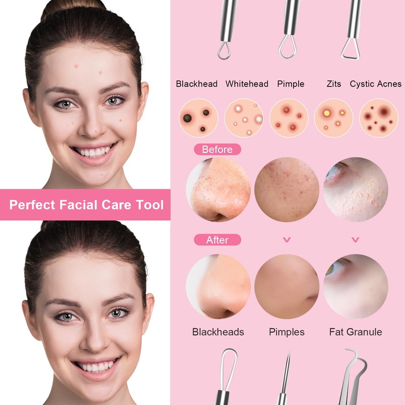 Fangze Blackhead Remover Tool Kit - 6pcs Pimple Popper Tool