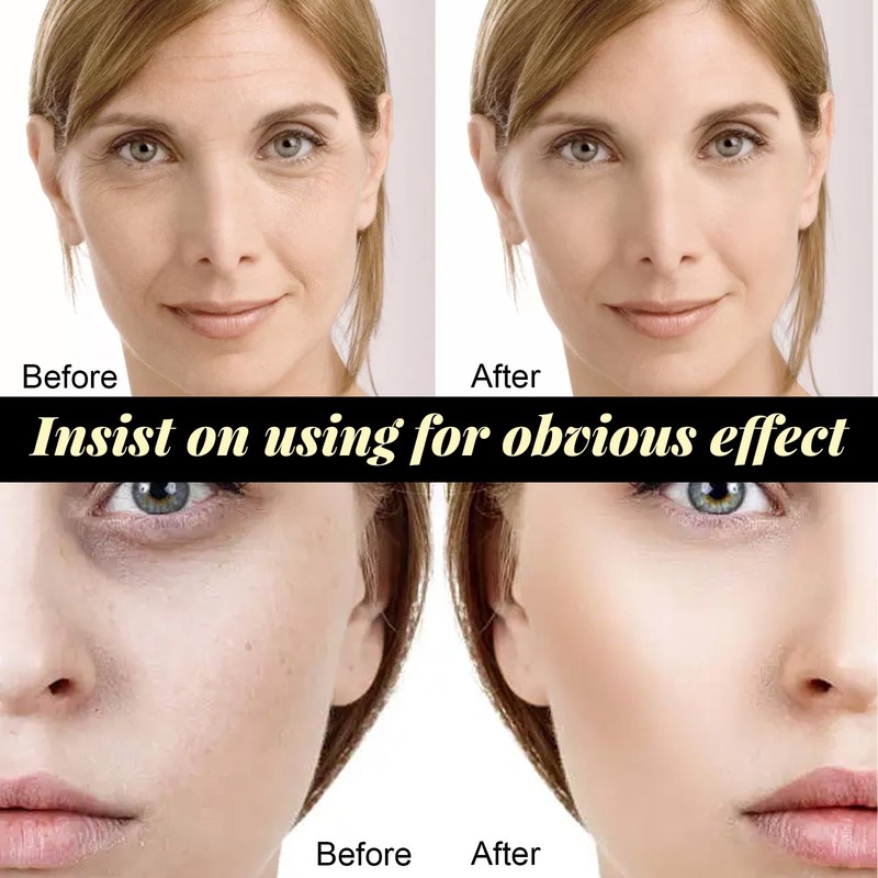 Protein Thread Lifting Set, Absorbable Collagen Thread, Active Collagen Silk