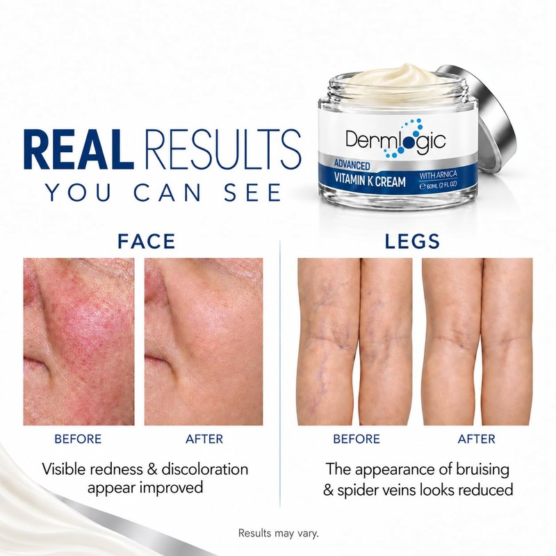 Vitamin K Cream- Moisturizing Bruise Healing Formula. Dark Spot Corrector