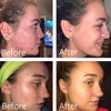 Dr Song Benzoyl Peroxide Wash 10% Acne Treatment: Acne Face