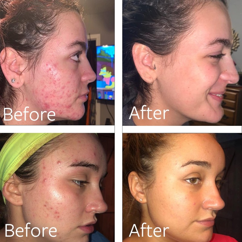 Dr Song Benzoyl Peroxide Wash 10% Acne Treatment: Acne Face
