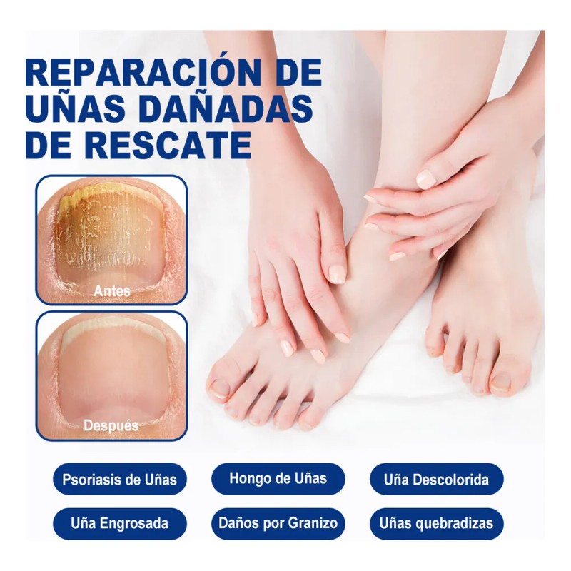 Kit 2 Uñas Hongo Líquido-inhibición 99% Hongos 30ml*2