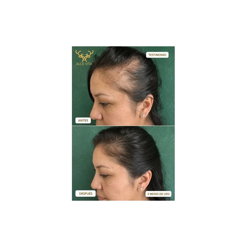 1 Shampoo Anticaída Y Crecimiento Chile Y Romero Vital Root