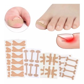 Dolores Kit Pedicure Corrector Uña Tratamient Enterradas Herramienta