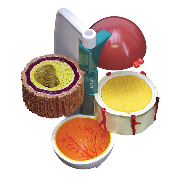 GPI Anatomicals - 4-Piece Diabetes Model, Replica Showing Vascular Effects on