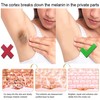 LYDIMOON Underarm melanin removal cream Neck/armpit/elbow/Black acanthoderm precipitation desalination private