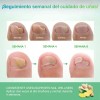 Parches Antimicóticos For El Tratamiento De Uñas