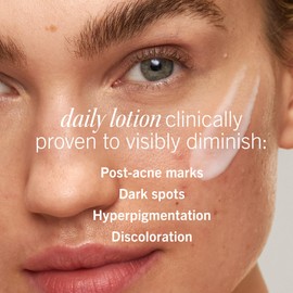 First Aid Beauty Lactic Acid Lotion for Acne-Prone Skin - 2% Niacinamide Acne Spot Treatment - Resurfacing Lotion Moisturizes & Visibly Dimishes Post-Acne Marks, (1.0 oz)