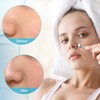 Blackhead Remover Tool Stainless Steel Pimple Popper Double Head Tool