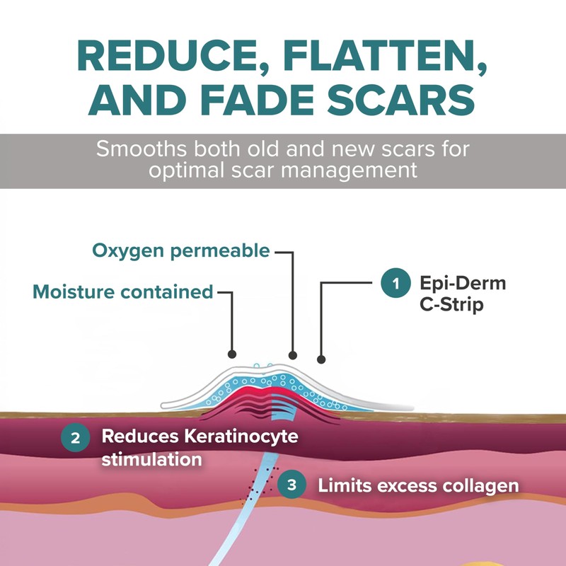 Epiderm Silicone Gel Scar Sheets - Premium-Grade Silicone Scar Sheets