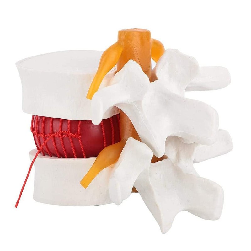 TOBEOME 1:1.5 Human Demonstration Model for Herniated Disc of the