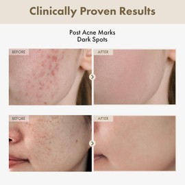 TOSOWOONG TOSOWOONG Alpha Arbutin 2 Rice Serum, Rice 746,074ppm, Alpha-Arbutin 20,000ppm, Glow, Glass skin, Pigmentation, Acne Marks, Dark Spots, Even Skin Tone, Hydrating, Korean Skin Care, 33ml / 1.11 fl. oz.