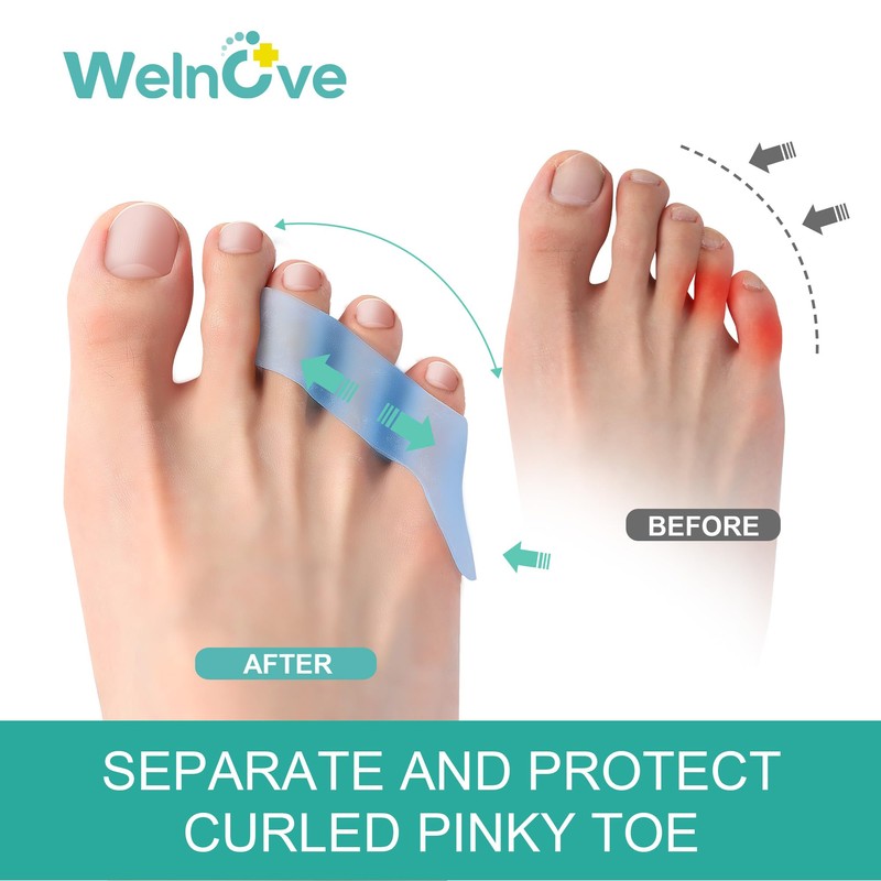 Welnove 12-Pack Gel Pinky Toe Separators - Little Toe Spacers