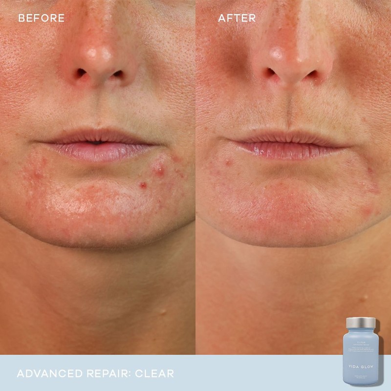 Vida Glow Clear Advanced Repair- 30 Capsules