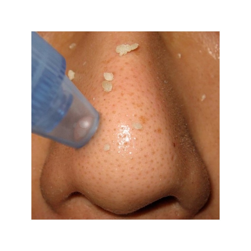 피지제거기 피지흡입기 블랙헤드제거 압출기 얼굴 코 Pore Remover Pore Suction