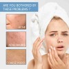 Gel Retinoide Tópico Para El Tratamiento Del Acné