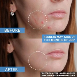 Gel Antiacné Curist Adapalene 0.1% (45 G, 1.6 Oz, Suministro