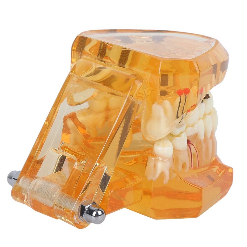 Dental Model Dental Disease Teaching Model Removable Implant Teeth Model