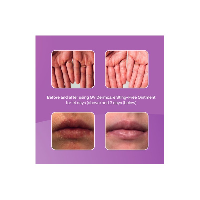 QV Ego QV Dermcare Sting-Free Ointment 100g