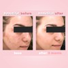 Biotrade 3 Simple Levels for Healthy Skin No Acne Removes