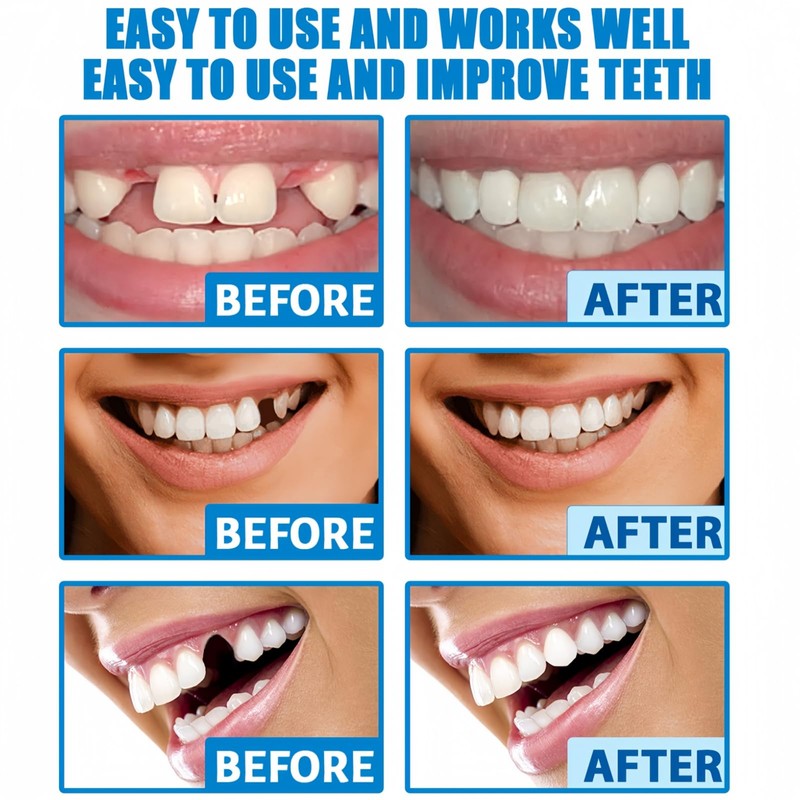 Temporary Tooth Filling Repair Kit - Moldable Tooth Repair Beads