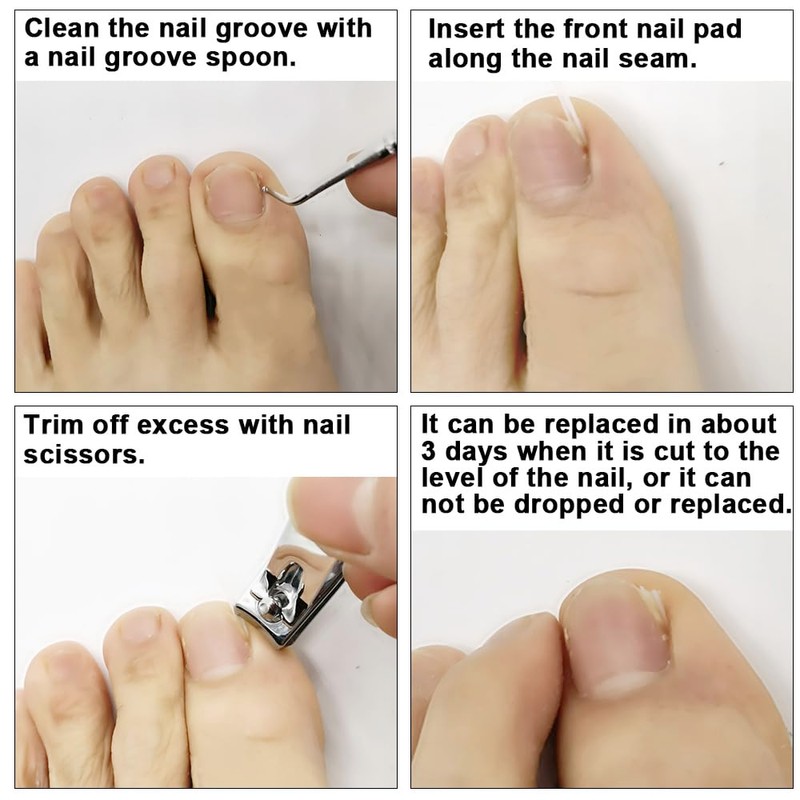 2 Piece Set Ingrown Toenail Correction Strips Brace Kit Ingrown