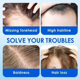 60ML Kopfhaut Serum für Männer & Frauen,Haarwachstumsserum,Natürliches Haarwachstum,For Volleres & stärkeres Haar,Verdicken und stärken für Haarwuchs,für spärliches Haar verwendet