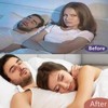 METFJSNY Anti Snoring Devices,New Upgraded Snore Stopper for Men and