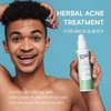 CIZ Body Acne Spray, Herbal Formula, 2%Salicylic Acid, Tea Tree