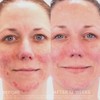 Rodan + Fields Unblemish Dual Intensive Acne Treatment | 0.76