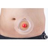 Alcare 21011 Stoma Orthotic Fixing Tape Pouch Accessories Face Plate
