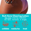 Butt Acne Clearing Lotion (2 pack) for back, buttocks, &