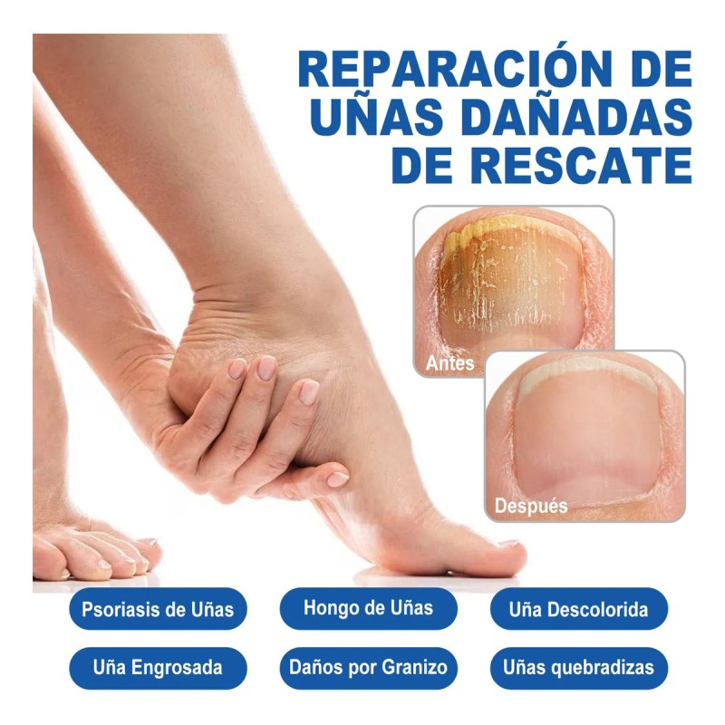 Líquido Antibacteriano De Uñas Grises Uñas Enfermas 30ml
