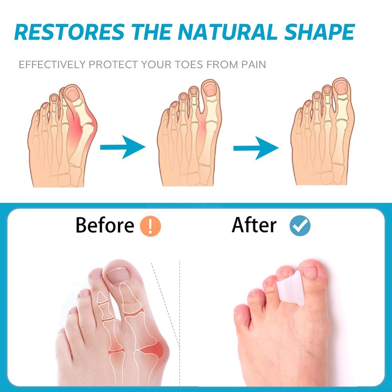 Nolimvita Hammer Toe Straightener Corrector - Toe Spacers Toe Splints