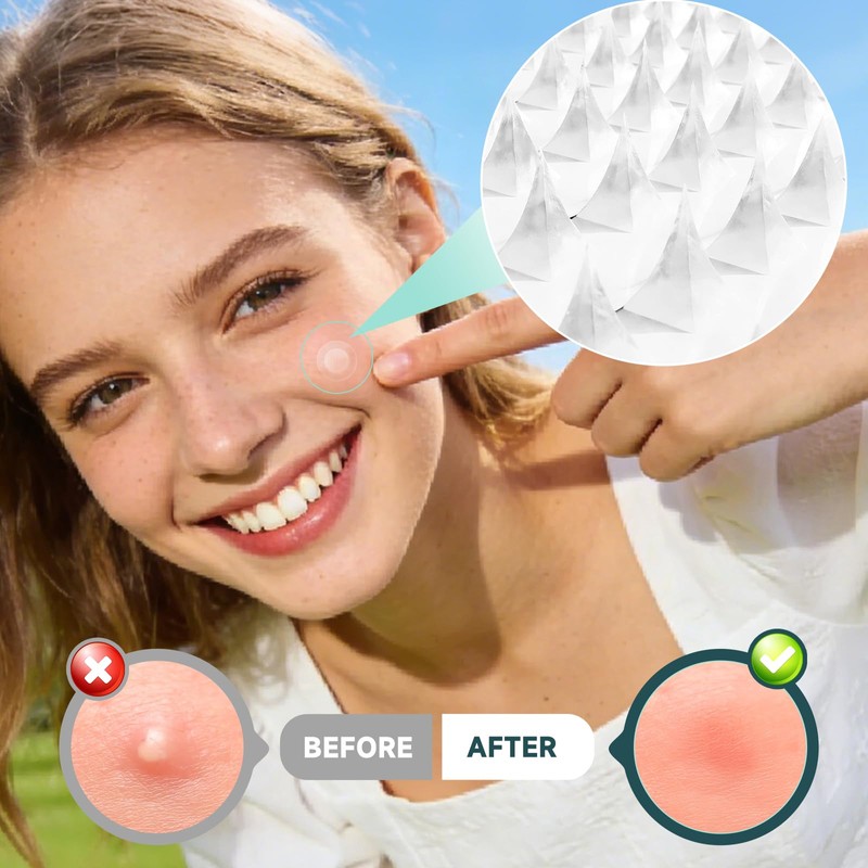 Microdart Pimple Patches for Face 9 Count,Hydrocolloid Zit Acne Patches