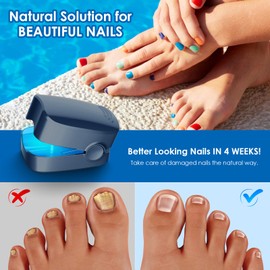 Nail Fungus Device for Toenail Repair for Discolored, Thickened, Home Use Toenail Fungus Device, Safe and Highly Effective Blue