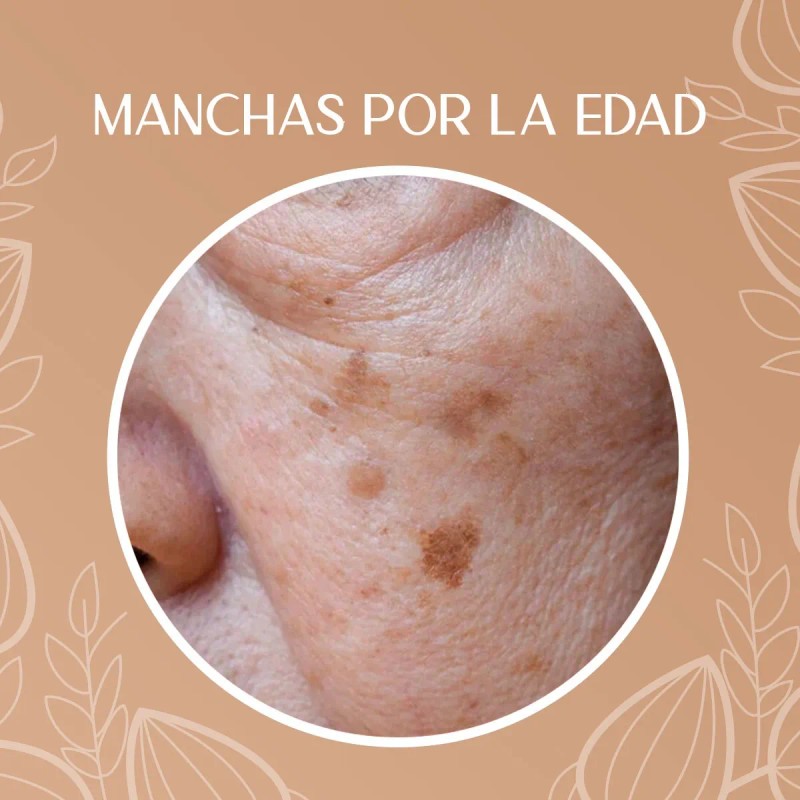 Crema Despigmentante Manchas Melasma Acné Paño