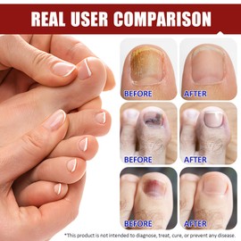 32 pieces multi-purpose toenail pads, nail digging repair patches, mushroom nail patches, toenail correction patch, nail fungus plasters for damaged nails and the appearance of discoloured nails