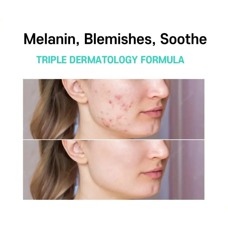 Tratamiento De Melasma Para Crema Facial
