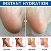Urea Foot Cream 60 Percent, Cracked Heel Repair Cream, Foot