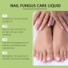 Líquido Para Hongos En Uñas - Cura Hongos Y Onicomicosis